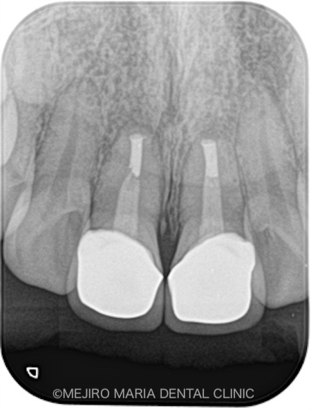目白マリア歯科｜ブログ｜【症例】歯根端切除術の失敗をリカバリー（歯根端切除術）｜術後レントゲン画像_治療後3