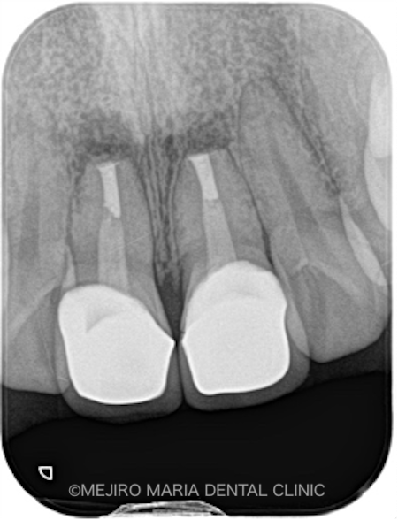 目白マリア歯科｜ブログ｜【症例】歯根端切除術の失敗をリカバリー（歯根端切除術）｜術直後レントゲン画像_治療後2