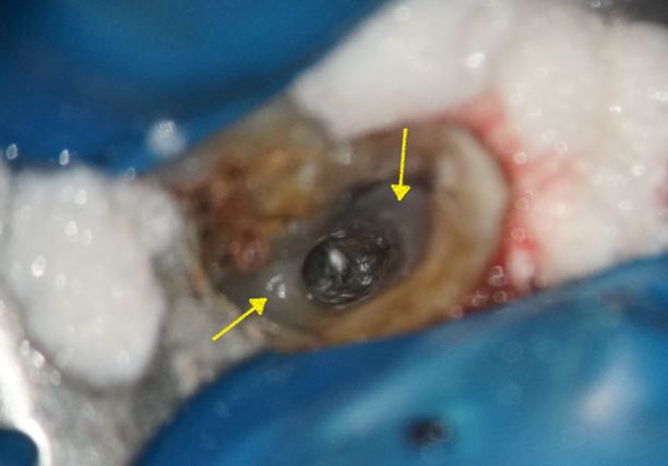 【症例】精密根管治療の費用対効果の考え方・再根管治療_残存していた歯科材料