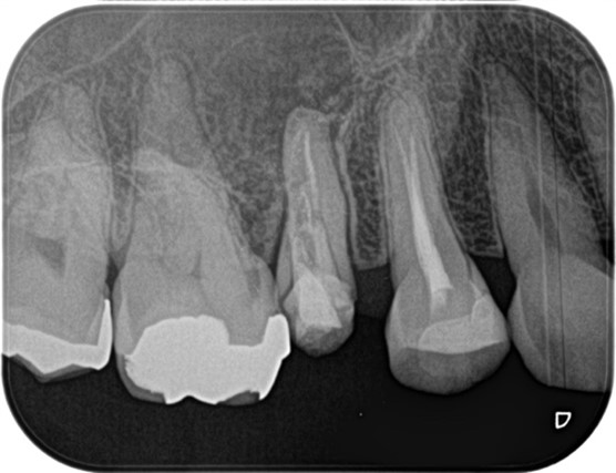 【症例】精密根管治療の費用対効果の考え方・再根管治療_治療前レントゲン画像