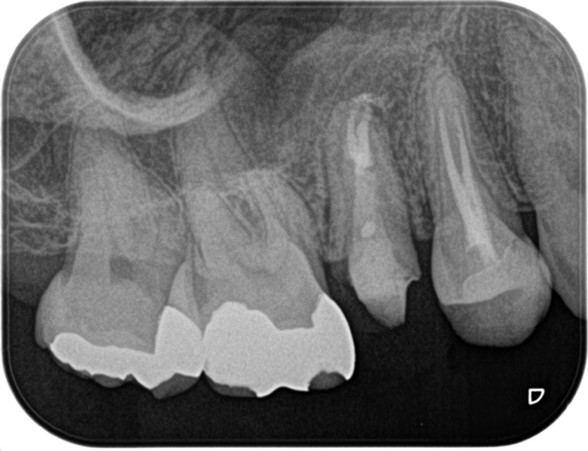【症例】精密根管治療の費用対効果の考え方・再根管治療_術後3ヶ月のレントゲン画像