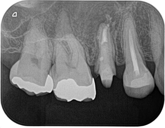 【症例】精密根管治療の費用対効果の考え方・再根管治療_術直後レントゲン画像