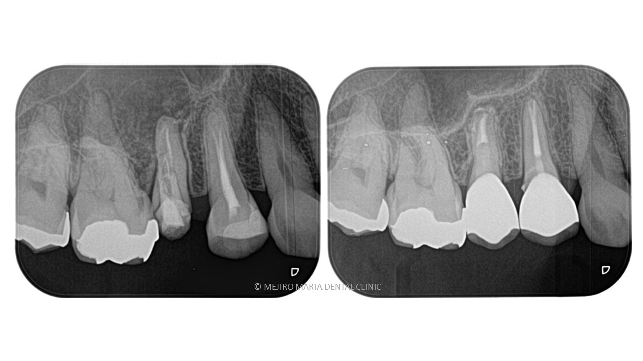 目白マリア歯科【症例】精密根管治療の費用対効果の考え方・再根管治療_治療前治療後のレントゲン画像比較