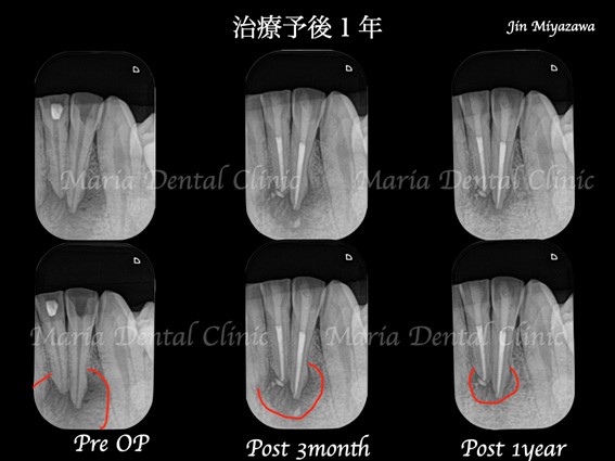 【症例】大きくなりすぎた根尖性歯周炎を2回の根管治療で治癒へ｜予後1年病変縮小が確認できるレントゲン画像