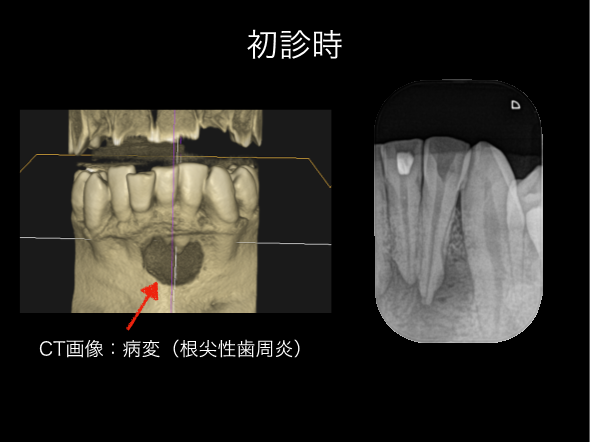 【症例】大きくなりすぎた根尖性歯周炎を2回の根管治療で治癒へ｜再根管治療_初診時のCTとレントゲンの画像