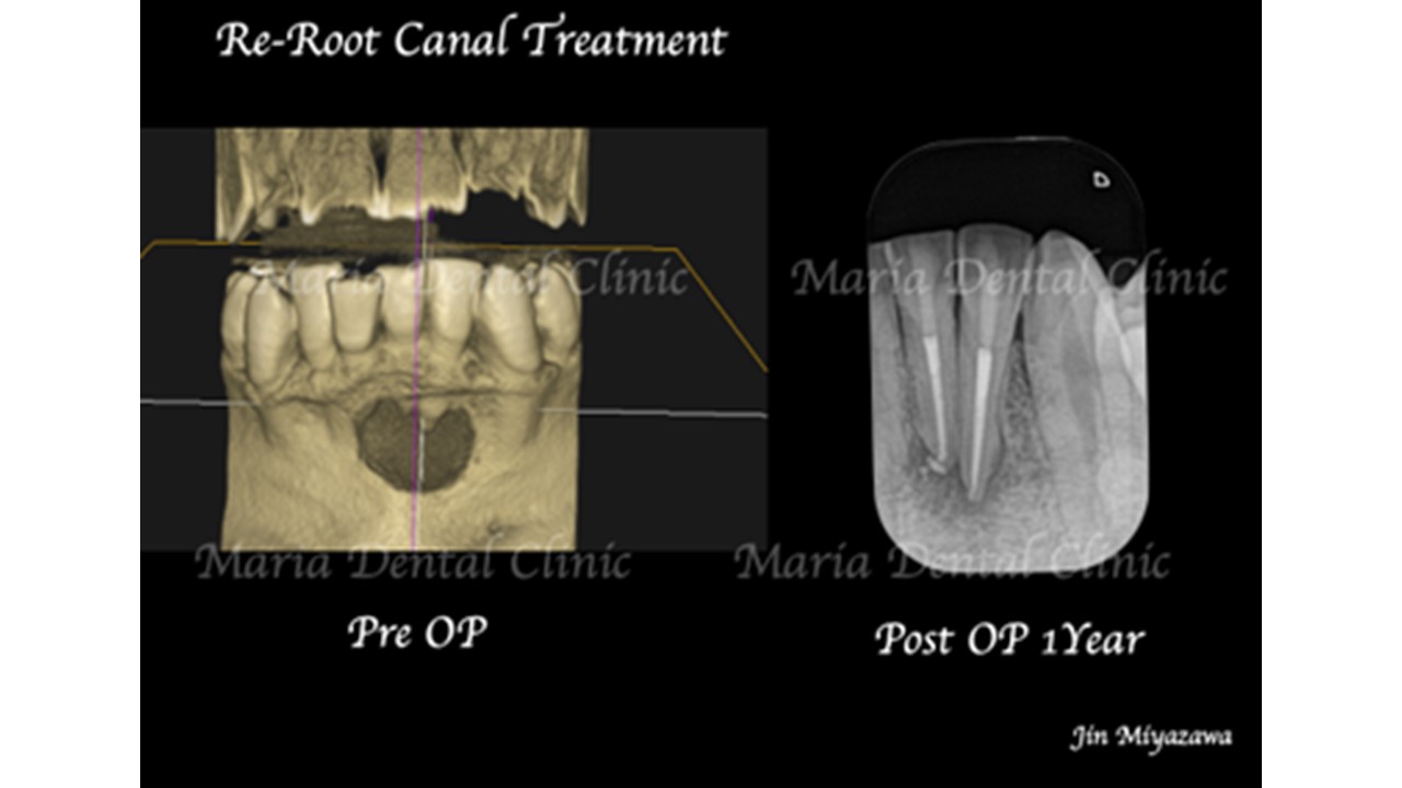 【症例】大きくなりすぎた根尖性歯周炎を2回の根管治療で治癒へ｜再根管治療_術前CT画像と術後1年のレントゲン画像