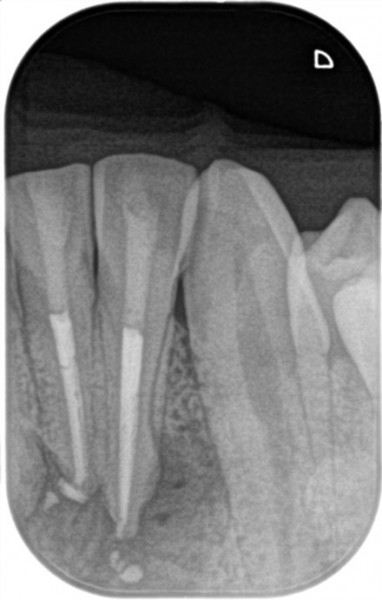 【症例】大きくなりすぎた根尖性歯周炎を2回の根管治療で治癒へ｜治療直後のレントゲン画像