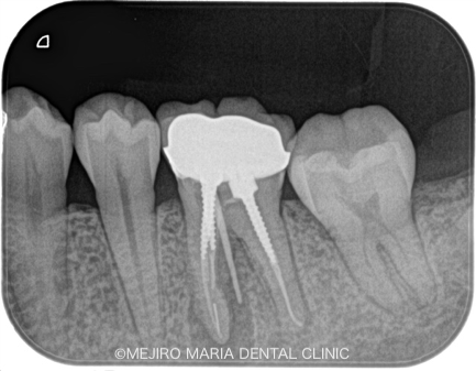 精密根管治療の症例｜根管治療のトラブルケース:「破折ファイル」の対処法と考え方｜破折ファイル除去治療前のレントゲン画像｜目白マリア歯科