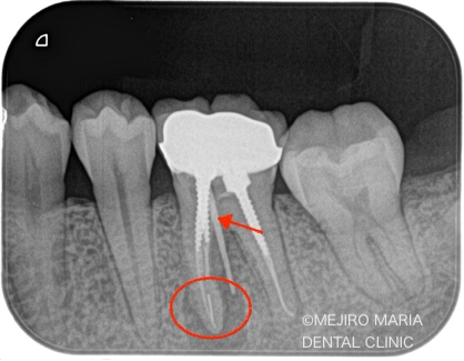 精密根管治療の症例｜根管治療のトラブルケース:「破折ファイル」の対処法と考え方｜破折ファイル除去治療前のレントゲン画像2｜目白マリア歯科