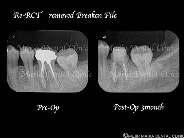 精密根管治療の症例｜根管治療のトラブルケース:「破折ファイル」の対処法と考え方｜破折ファイル除去治療前後の比較画像2｜目白マリア歯科