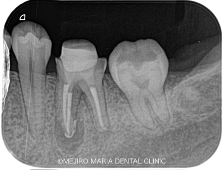 精密根管治療の症例｜【症例】・根管治療の際に取り残された器具（リーマー・ファイル）の除去｜治療直後のレントゲン画像｜目白マリア歯科
