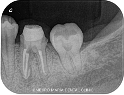 精密根管治療の症例｜【症例】・根管治療の際に取り残された器具（リーマー・ファイル）の除去｜治療後3ヶ月のレントゲン画像｜目白マリア歯科