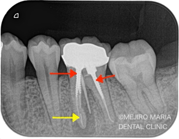 精密根管治療の症例｜【症例】・根管治療の際に取り残された器具（リーマー・ファイル）の除去｜治療詳細のレントゲン画像｜目白マリア歯科