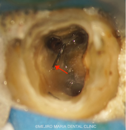 精密根管治療の症例｜【症例】・根管治療の際に取り残された器具（リーマー・ファイル）の除去｜根管内の破折ファイル｜目白マリア歯科