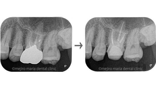 目白マリア歯科｜【症例】被せ物の前に行う予防的な根管治療｜治療前後の比較画像