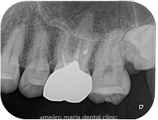目白マリア歯科｜【症例】被せ物の前に行う予防的な根管治療｜治療前の画像1