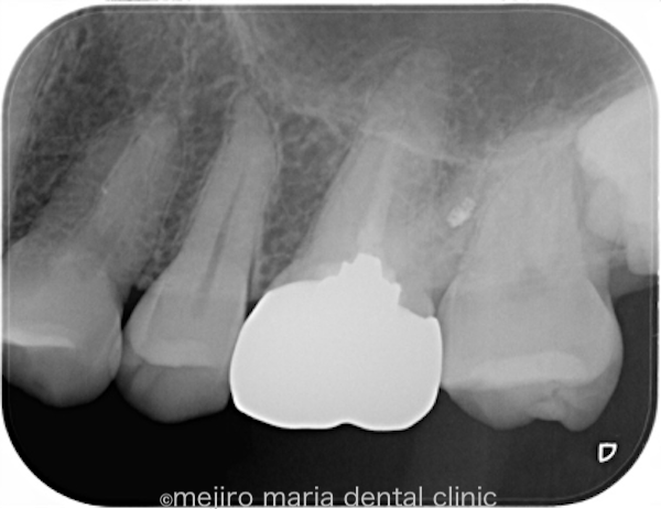 目白マリア歯科｜【症例】被せ物の前に行う予防的な根管治療｜治療前の画像2