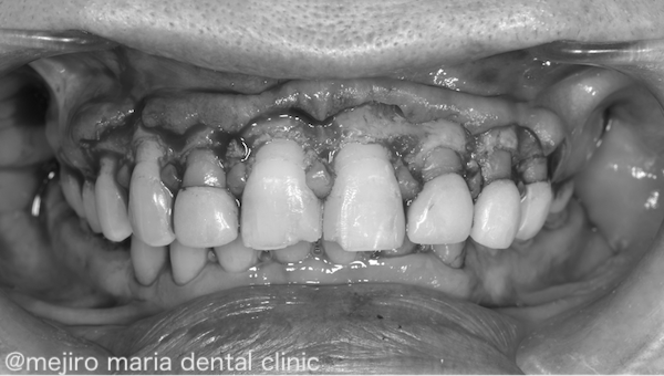 目白マリア歯科｜歯周形成外科の症例｜【症例】ガミースマイルに対し歯冠長延長術を適用｜治療中の画像