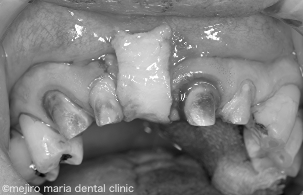 目白マリア歯科｜歯周形成外科の症例｜【症例】結合組織移植術（CTG）により審美を改善｜治療詳細画像①
