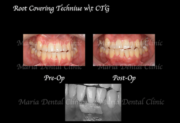 目白マリア歯科｜歯周形成外科の症例｜【症例】矯正治療による歯茎下がりを歯茎の移植で改善｜治療前後の比較画像