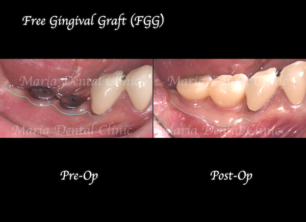 目白マリア歯科｜歯周形成外科の症例｜【症例】結合組織移植術（CTG）により審美を改善｜治療前後の比較画像