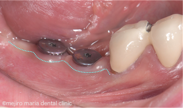 目白マリア歯科｜歯周形成外科の症例｜インプラントを守るための歯茎の移植（FGG）｜治療前の歯茎の画像
