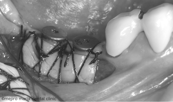 目白マリア歯科｜歯周形成外科の症例｜インプラントを守るための歯茎の移植（FGG）｜治療中の歯茎の画像