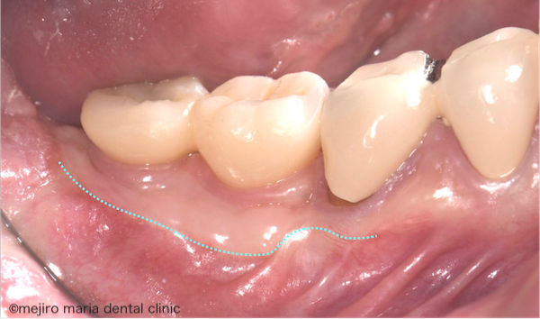 目白マリア歯科｜歯周形成外科の症例｜インプラントを守るための歯茎の移植（FGG）｜治療後の歯茎の画像