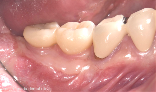 目白マリア歯科｜歯周形成外科の症例｜インプラントを守るための歯茎の移植（FGG）｜治療後の歯茎の画像
