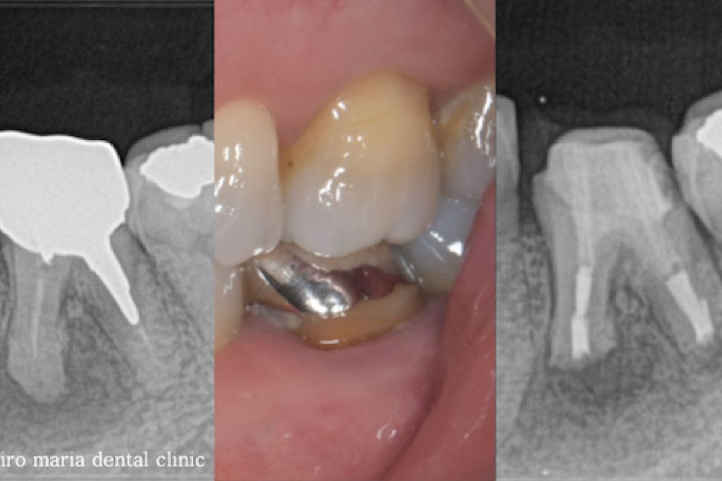 抜歯を宣告された歯・難治性の根尖性歯周炎を精密根管治療にて治癒