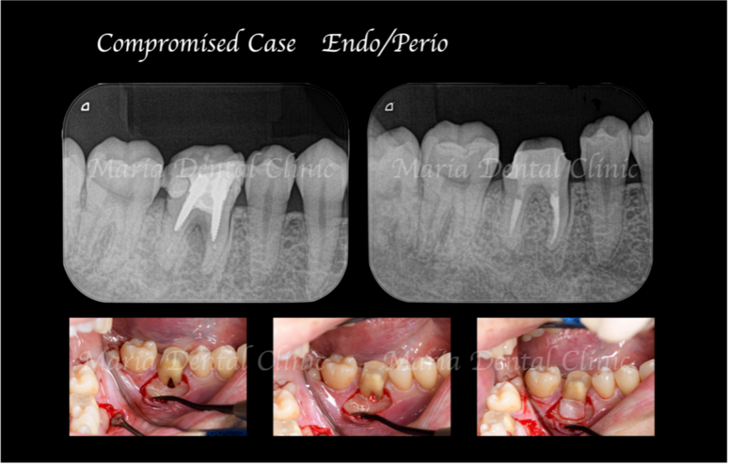 【症例】難症例・根の病気と歯周病が併発した症例２（世界基準の精密根管治療と最先端の歯周組織再生療法を用いて全ての問題を解決）