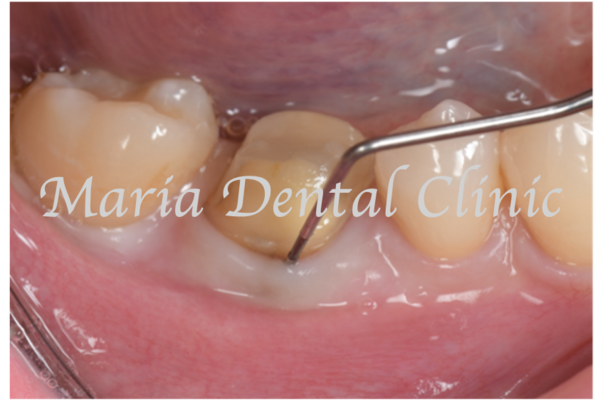 目白マリア歯科｜歯周形成外科の症例｜【症例】難症例・根の病気と歯周病が併発した症例２（世界基準の精密根管治療と最先端の歯周組織再生療法を用いて全ての問題を解決）｜比較治療前