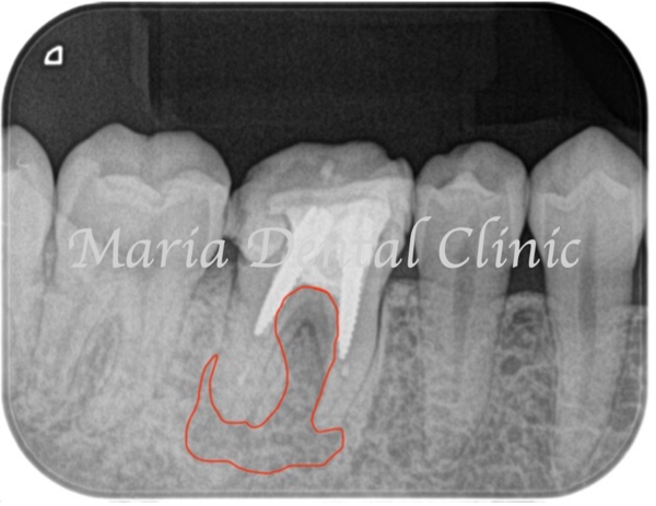 目白マリア歯科｜歯周形成外科の症例｜【症例】難症例・根の病気と歯周病が併発した症例２（世界基準の精密根管治療と最先端の歯周組織再生療法を用いて全ての問題を解決）｜術前レントゲン病変