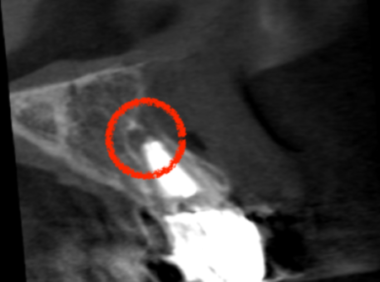 治療前レントゲン画像②|【症例】セラミック治療後に発症した根尖性歯周炎に対する歯根端切除術|目白マリア歯科