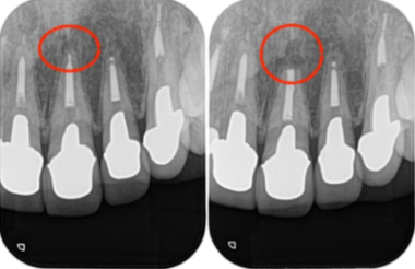 治療詳細レントゲン画像①|【症例】セラミック治療後に発症した根尖性歯周炎に対する歯根端切除術|目白マリア歯科
