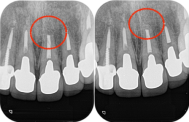 治療詳細レントゲン画像②|【症例】セラミック治療後に発症した根尖性歯周炎に対する歯根端切除術|目白マリア歯科