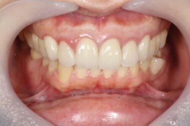 治療後画像②|【症例】セラミック治療後に発症した根尖性歯周炎に対する歯根端切除術|目白マリア歯科