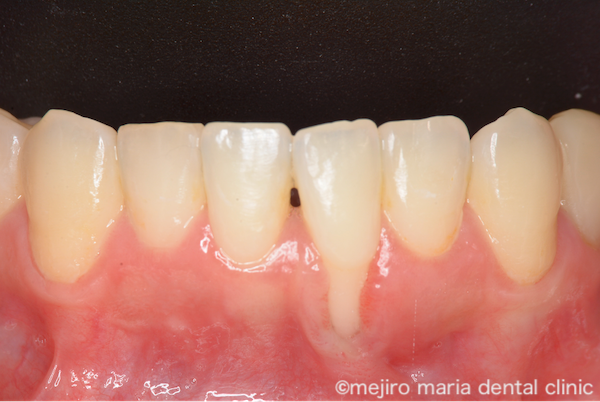 目白マリア歯科|歯周形成外科の症例|【症例】矯正治療による歯茎下がりを歯茎の移植で改善|治療前の画像2