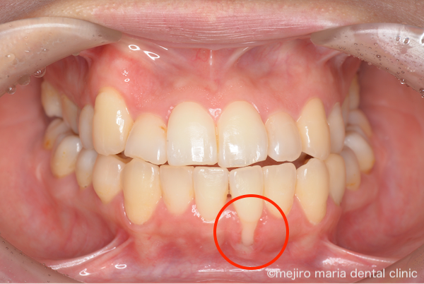 目白マリア歯科|歯周形成外科の症例|【症例】矯正治療による歯茎下がりを歯茎の移植で改善|治療前の画像