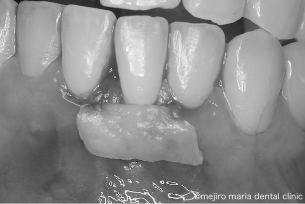 目白マリア歯科|歯周形成外科の症例|【症例】矯正治療による歯茎下がりを歯茎の移植で改善|治療中の画像