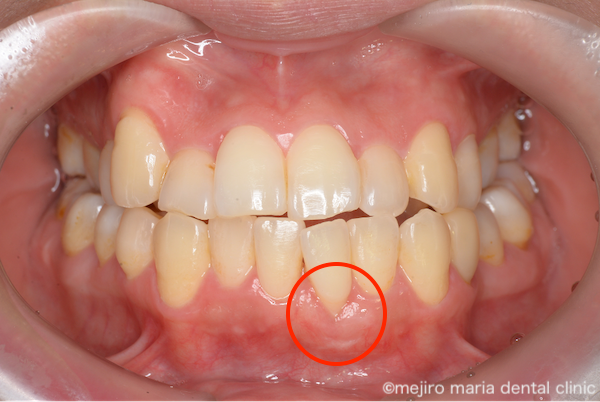 目白マリア歯科|歯周形成外科の症例|【症例】矯正治療による歯茎下がりを歯茎の移植で改善|治療後の画像