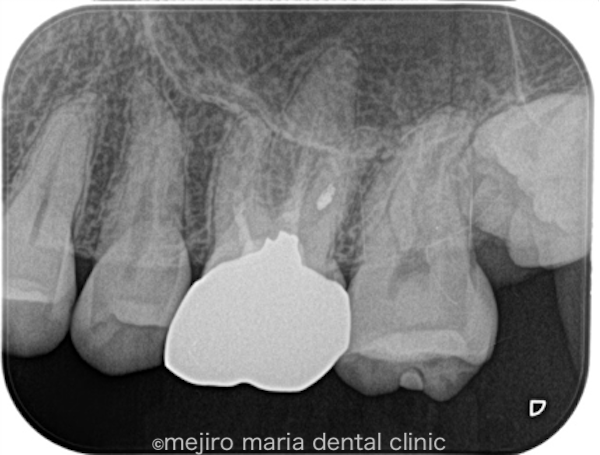 目白マリア歯科｜【症例】被せ物の前に行う予防的な根管治療｜治療前の画像2