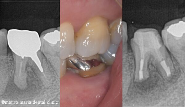 【症例】抜歯を宣告された歯・難治性の根尖性歯周炎を精密根管治療にて治癒