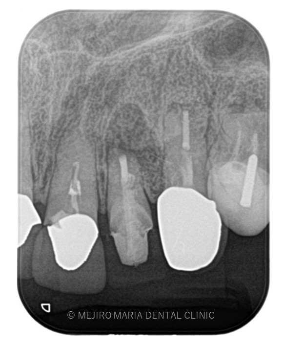 目白マリア歯科【症例】根尖部に充填された人工骨の感染により根尖性歯周炎が難治化。歯内療法（精密根管治療）でのリカバリー_該当歯牙の精密根管治療後のレントゲン画像