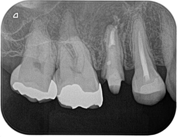 【症例】精密根管治療の費用対効果の考え方・再根管治療_感染物