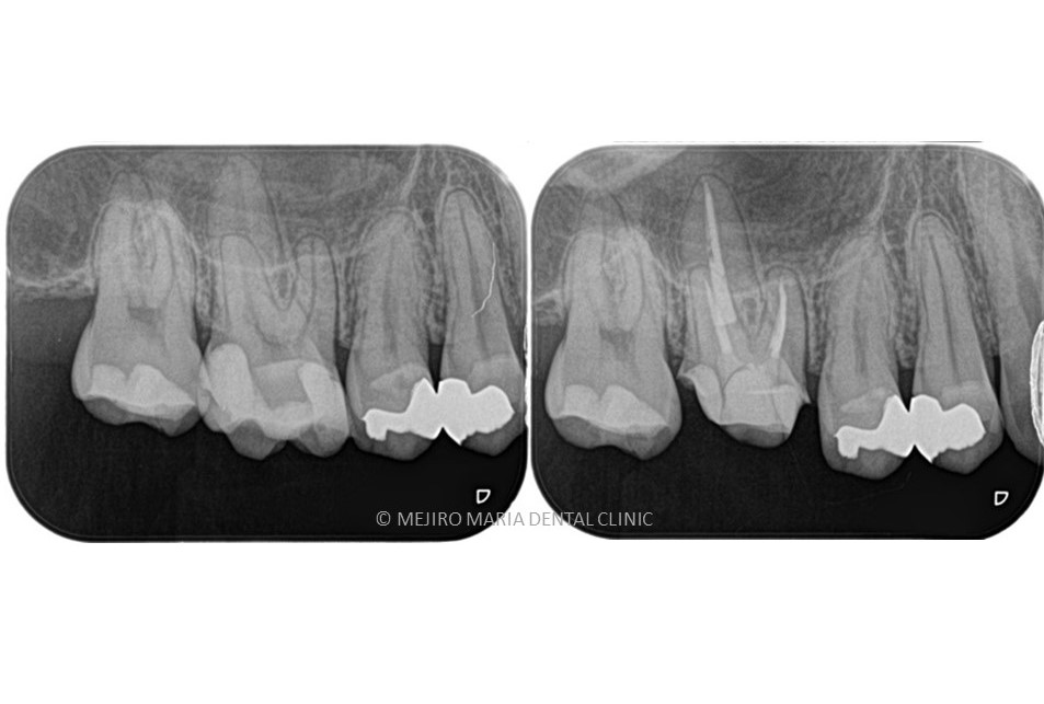 【症例】抜髄（初回根管治療）精密根管治療　～虫歯治療後に不可逆性歯髄炎に罹患した症例～