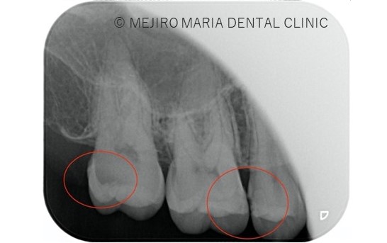 目白マリア歯科【症例】セラミック材料を使った修復処置・セラミック接着時の環境への配慮_治療前_虫歯箇所がわかるレントゲン画像