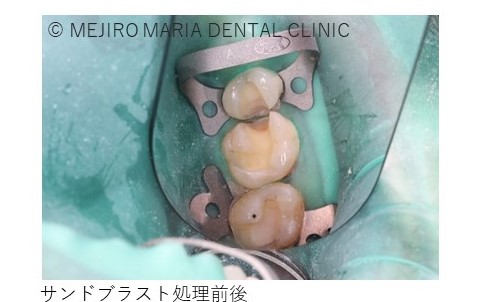 目白マリア歯科【症例】セラミック材料を使った修復処置・セラミック接着時の環境への配慮_治療詳細_サンドブラスト処理後