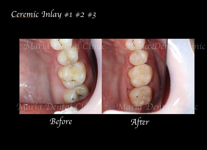 目白マリア歯科【症例】セラミック材料を使った修復処置・セラミック接着時の環境への配慮_術前術後のレントゲン画像比較