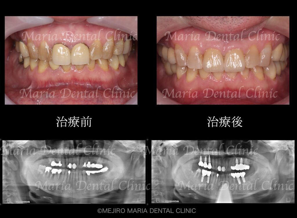 【症例】チーム医療で行った全顎的な治療：精密根管治療による歯の保存と咬合崩壊を防ぐインプラント治療